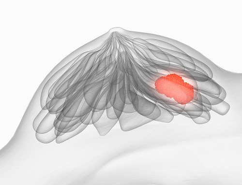 Anatomische Darstellung einer Brust mit hervorgehobenem Bereich zur Veranschaulichung eines Tumors bei Brustkrebs.