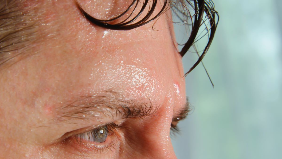 Visualisierung Hyperhidrosis Grad III des Gesichts