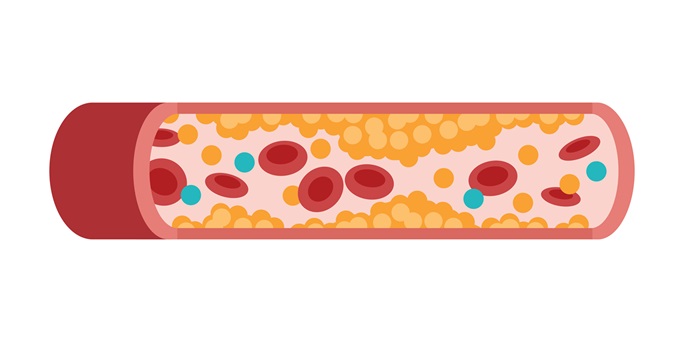 Medizinische Vektorillustration eines menschlichen Blutgefäßes mit verschiedenen Arten von Cholesterin