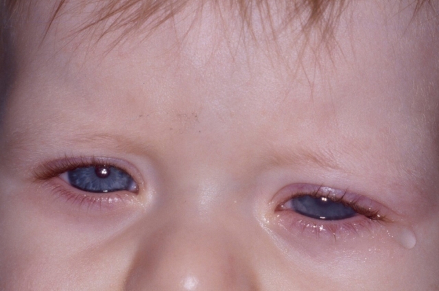 Tränendes Auge (Hypersekretion) und Blepharitis sind klassische Frühzeichen eines PCG. Bild: A. Jünemann