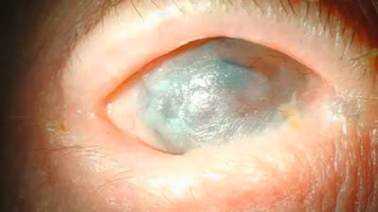 Okuläres Schleimhautpemphigoid