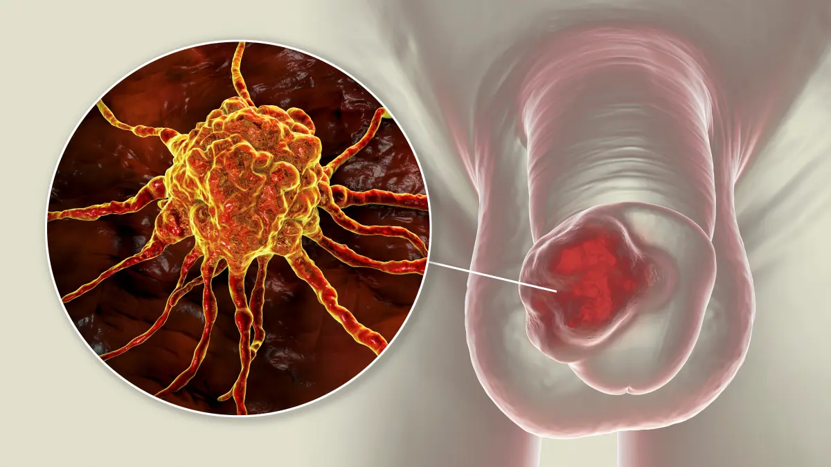 3D-Illustration eines Peniskarzinoms mit Detailansicht einer Krebszelle – Plattenepithelkarzinom des Penis (PSCC) als häufigste maligne Tumorentität