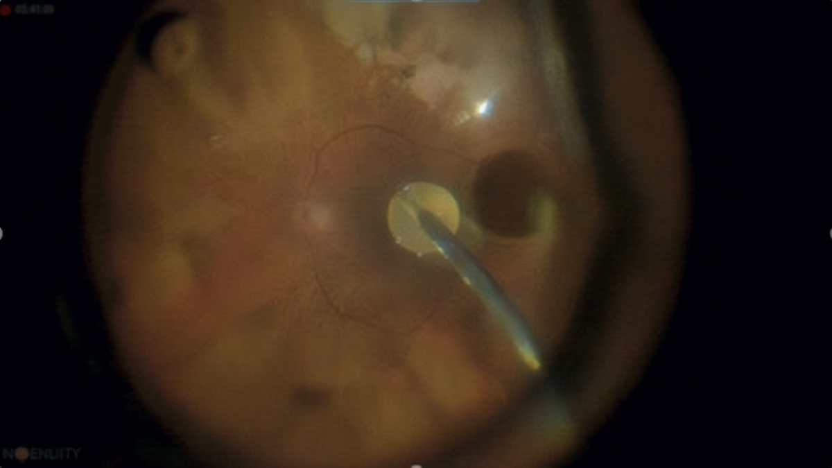Autologer Thrombozytenpatch in der Makulachirurgie